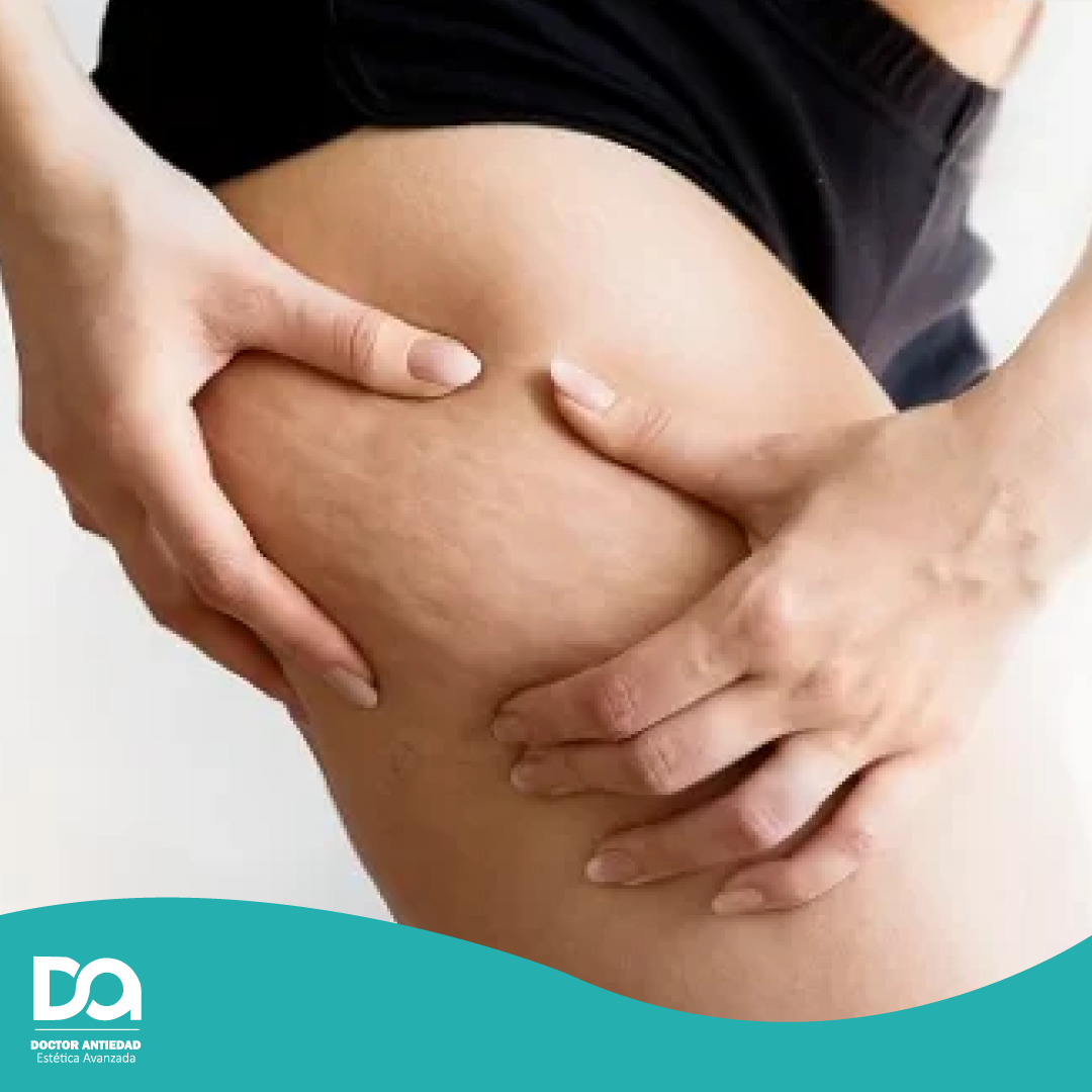 DR. ANTIEDAD carboxiterapia 2